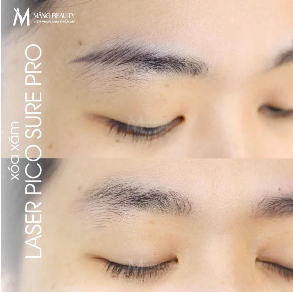 Măng Beauty sở hữu công nghệ xóa mới nhất Laser PicoSure Pro, giúp quá trình xóa an toàn và sạch mực chỉ trong vài buổi