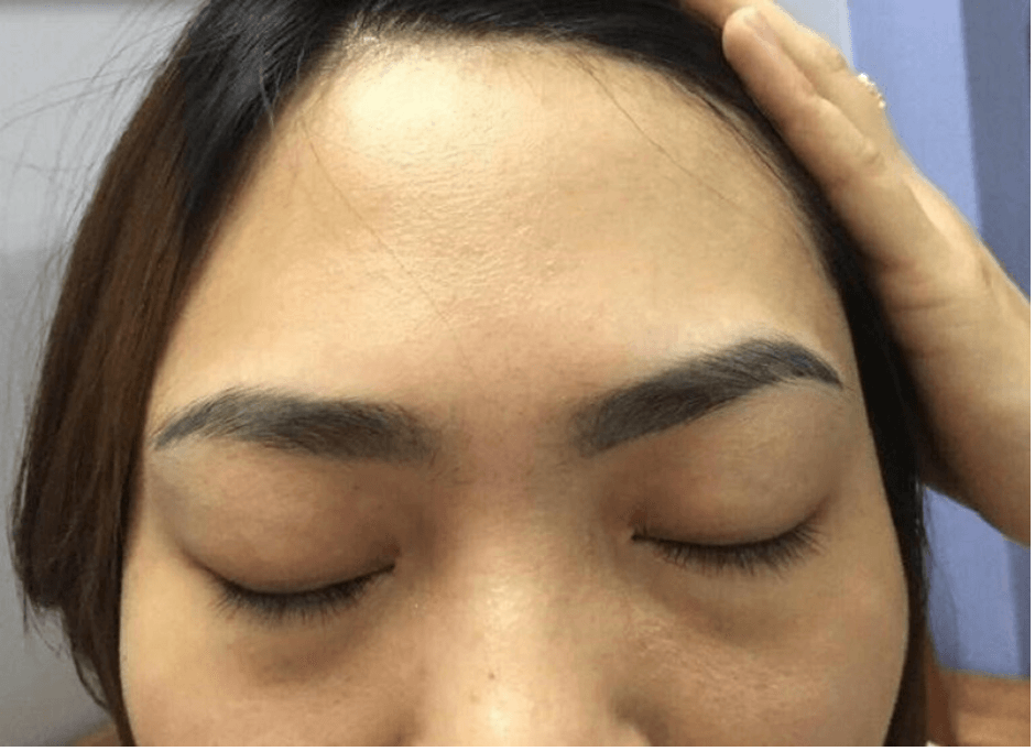 Những nền chân mày cũ mực quá đậm và sâu không thể xử lý xóa ngay mà cần thực hiện theo một lộ trình cụ thể