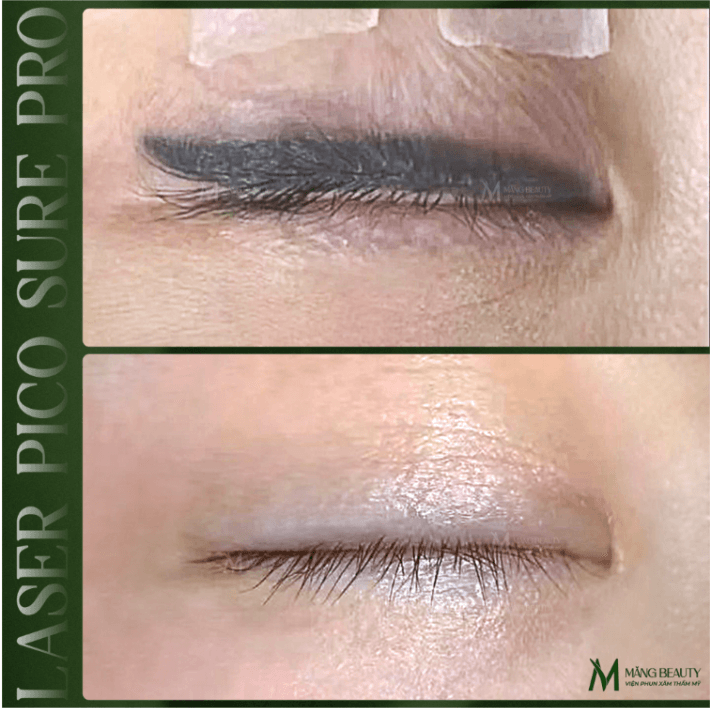 Xóa mí mắt là kỹ thuật sử dụng công nghệ laser hoặc plasma để phá vỡ mực xăm cũ 