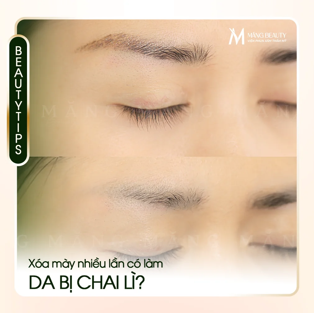 Xóa chân mày nhiều lần có làm da bị chai lì không? Sự thật ít ai nói