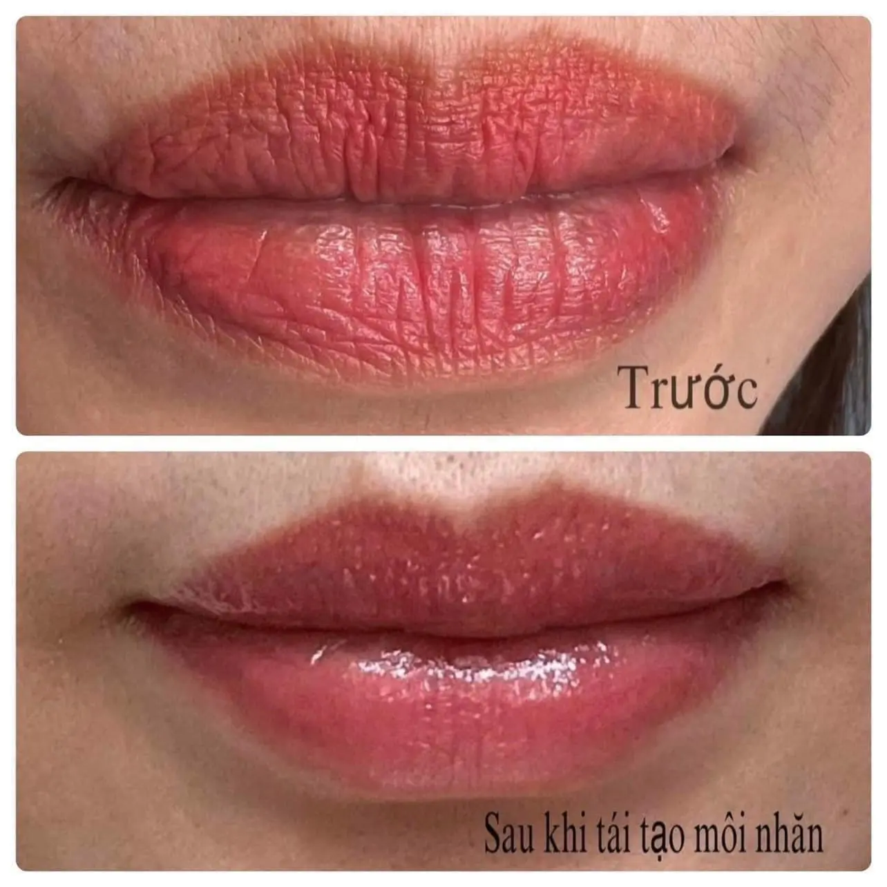 Công nghệ bắn Plasma môi là gì?