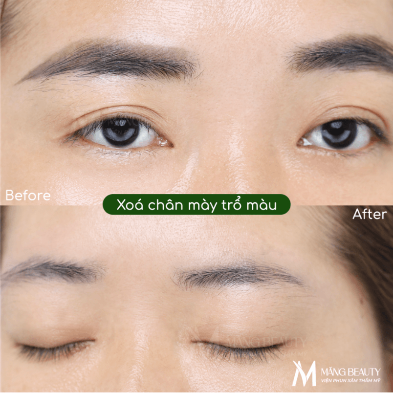 Xóa chân mày có bị rụng hoặc trắng lông không?