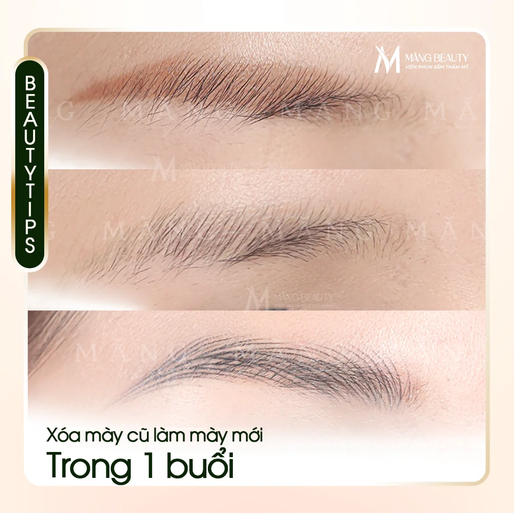 Xoá mày cũ, làm mày mới chỉ 1 buổi có thật không?
