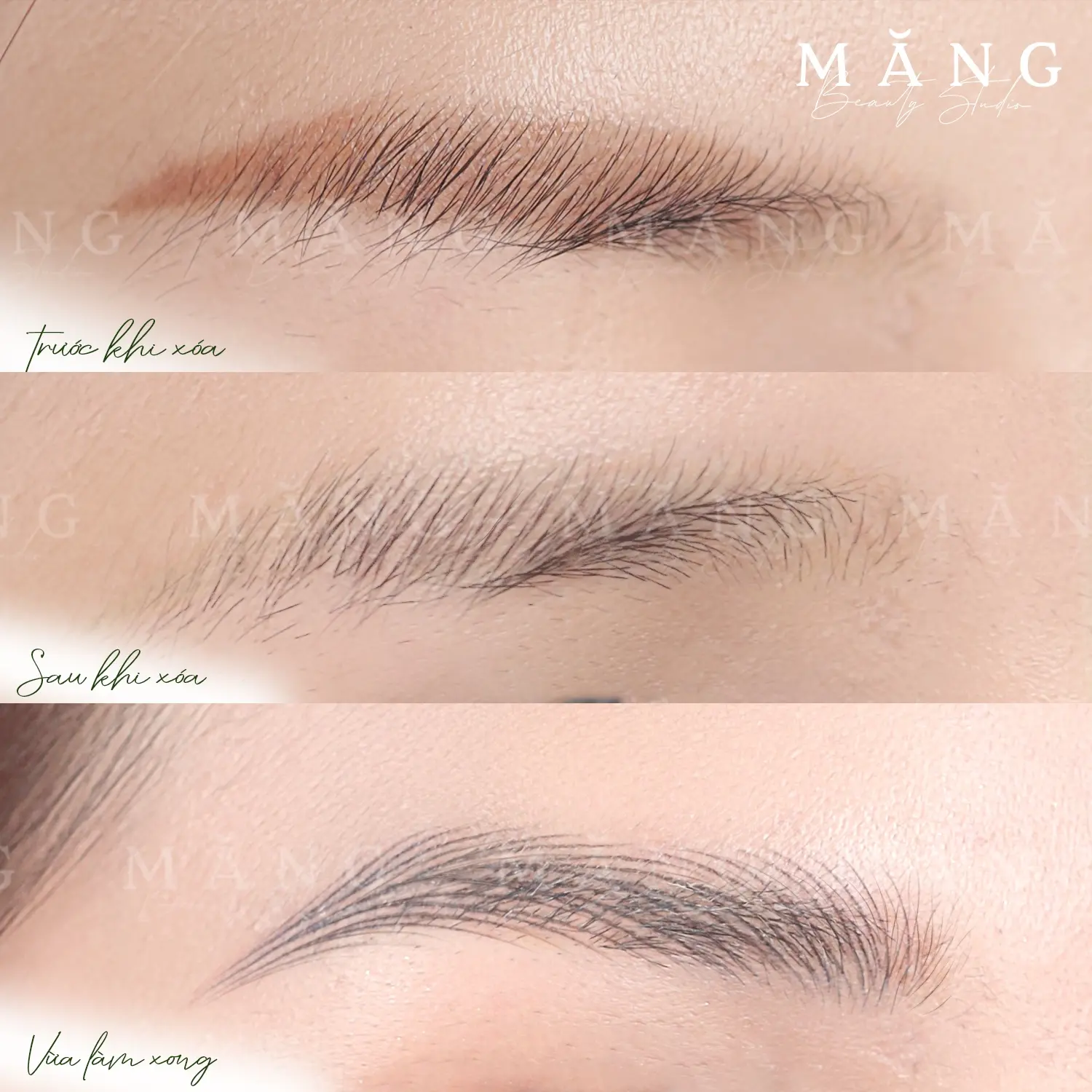 Hiệu quả xoá chân mày bằng Plasma và tái sinh chân mày mới tại Măng