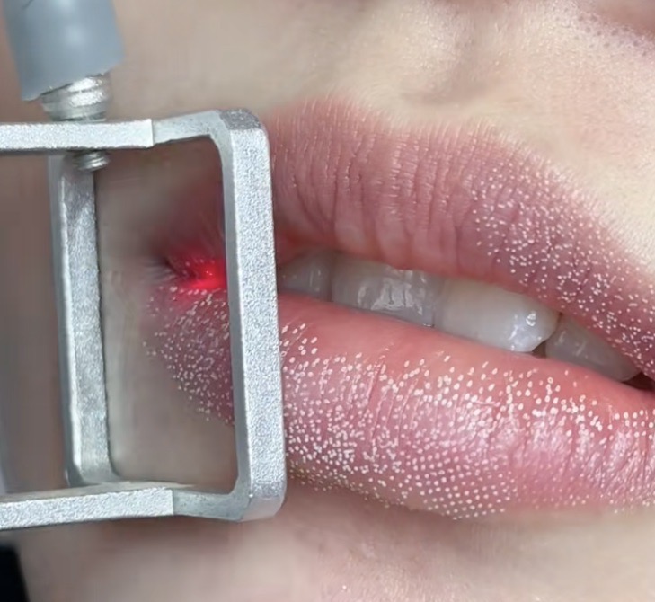 Laser Co2 - Phương pháp trẻ hoá môi hiện đại