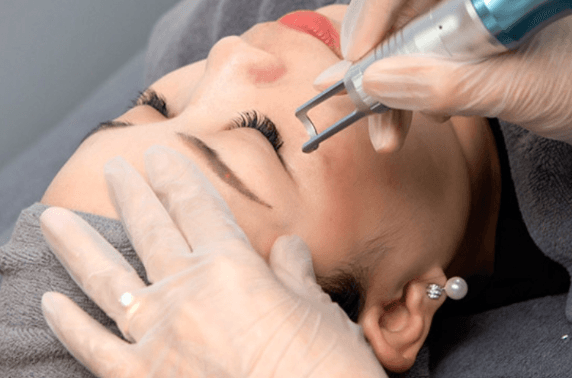 Xử lý mí phun trổ xanh bằng phương pháp xoá Laser an toàn