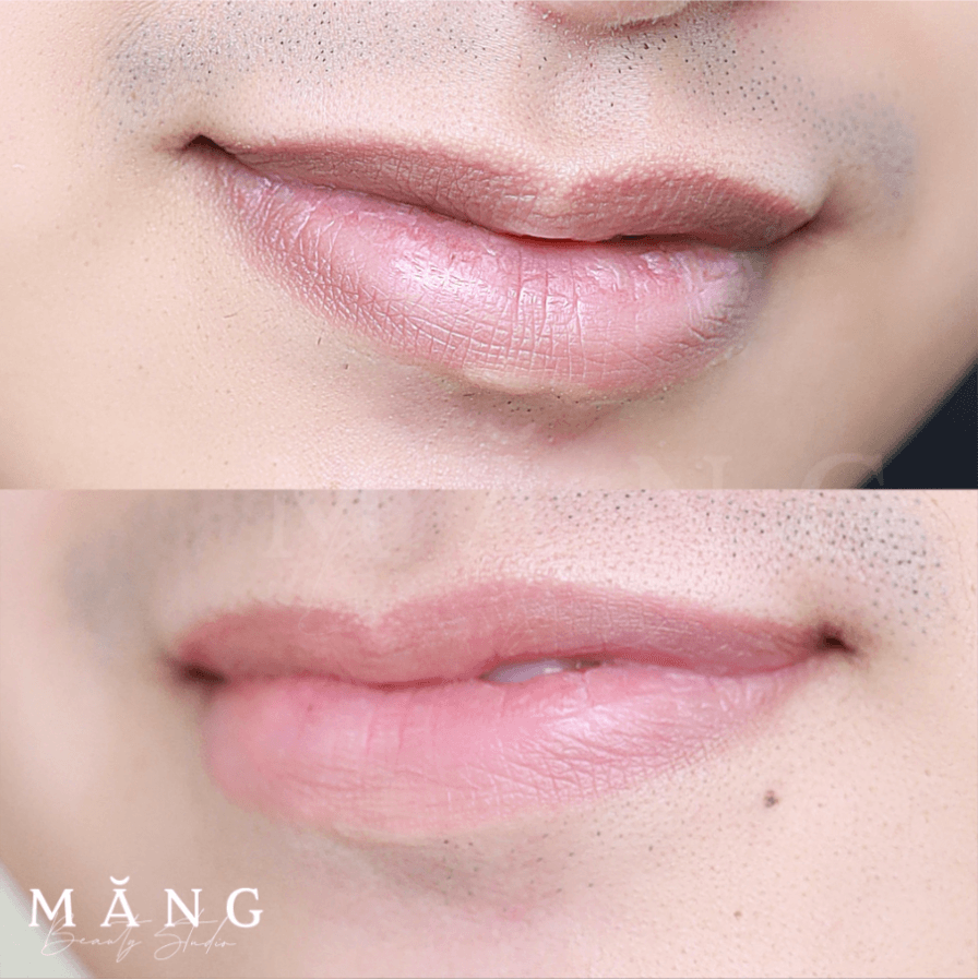 Những nền môi thâm xỉn có thể xử lý plasma để sáng và đều màu hơn