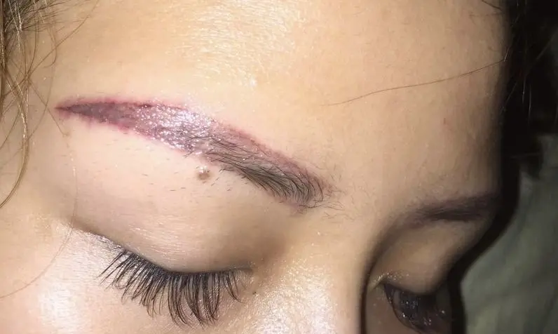 Kem xoá mực nồng độ cao nhưng không loại bỏ được hoàn toàn mực xăm