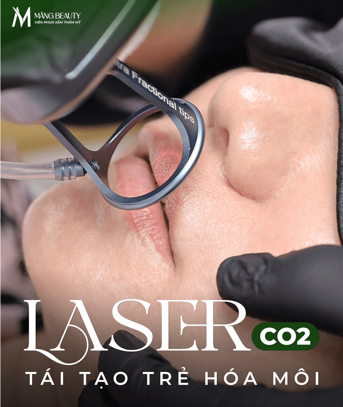 Quy trình thực hiện Laser CO2 môi an toàn tại Măng Beauty