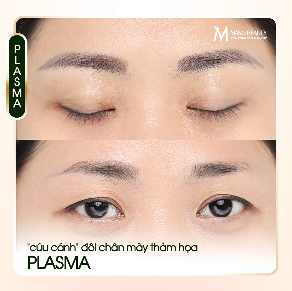 Xóa chân mày bằng Plasma tại Măng Beauty - Giải pháp “cứu cánh” đôi chân mày thảm họa