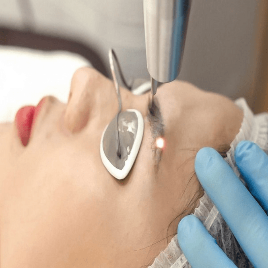 Quy trình xử lý mày xăm bị trổ đỏ bằng Laser Picosure Pro chuẩn Y khoa tại Măng Beauty