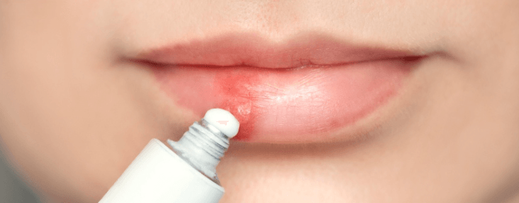 Hướng dẫn cách bôi Acyclovir sau phun môi đúng cách
