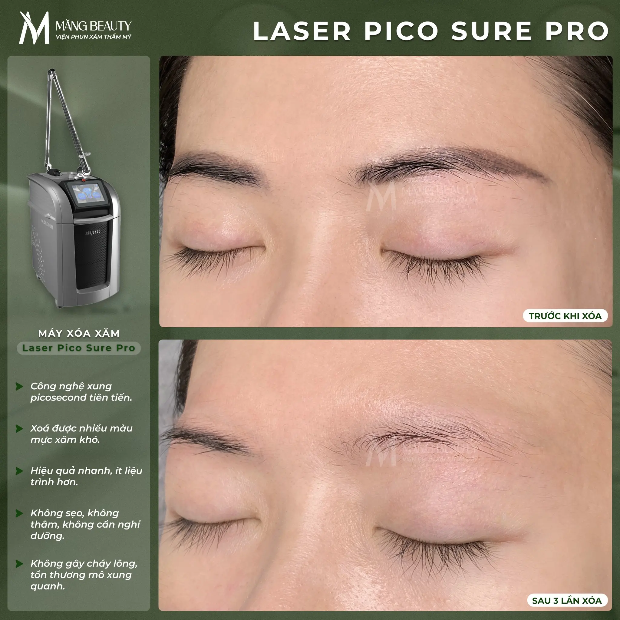 Laser Pico Sure Pro mang đến hiệu quả vượt trội, được nhiều khách hàng tin chọn tại Măng Beauty