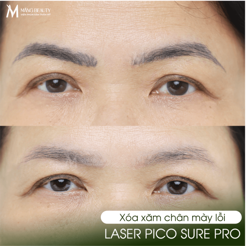 Nền da vẫn khỏe mạnh khi xóa chân mày bằng phương pháp Laser PicoSure Pro