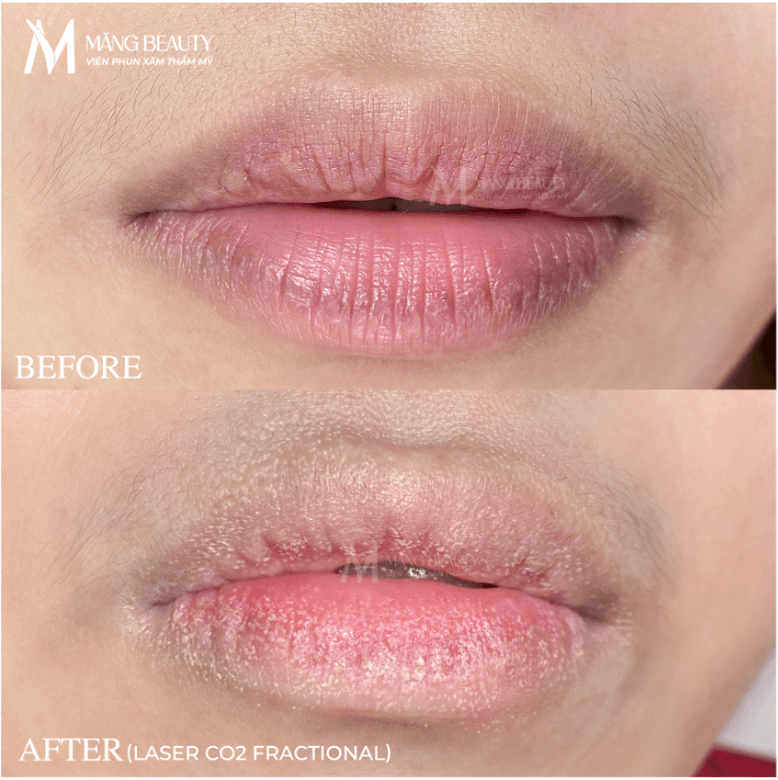 Lộ trình phục hồi của môi sau thực hiện Laser CO2 fractional