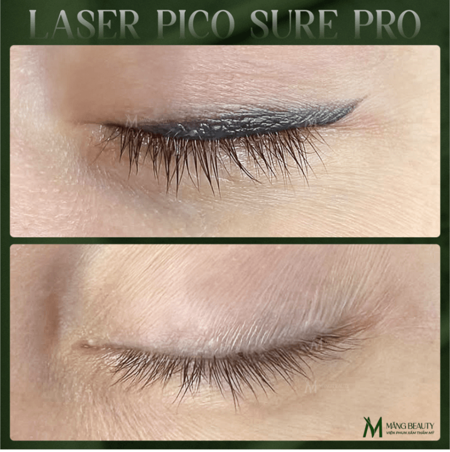 Laser PicoSure Pro là phương pháp xóa mí mắt an toàn và hiệu quả