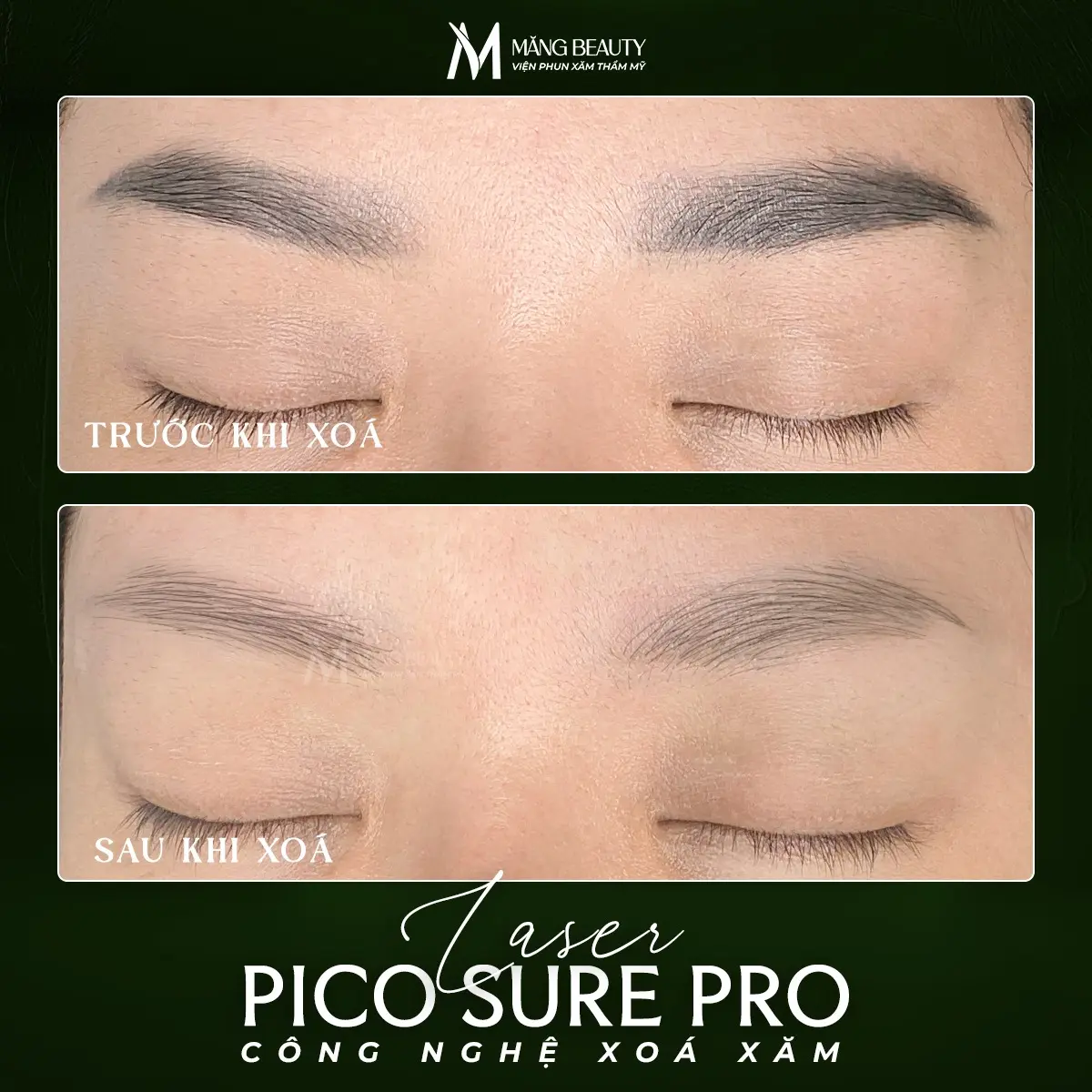 Xóa chân mày với công nghệ Laser Picosure Pro siêu hiệu quả, an toàn với làn da