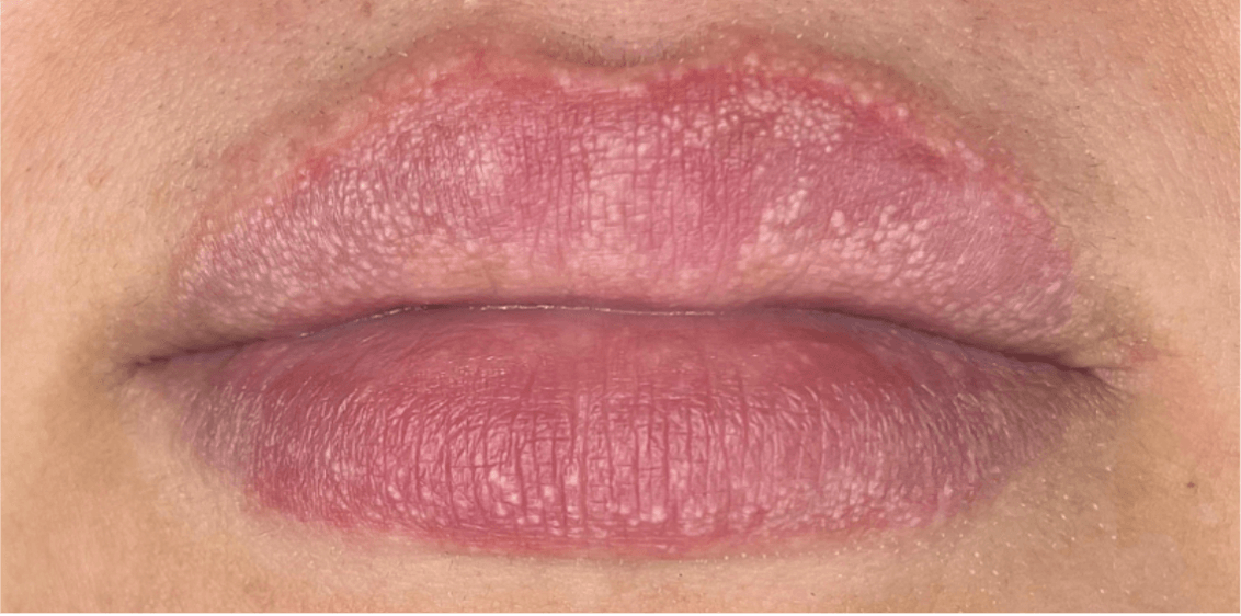 Plasma môi có thể xử lý được các hạt Fordyce trên môi