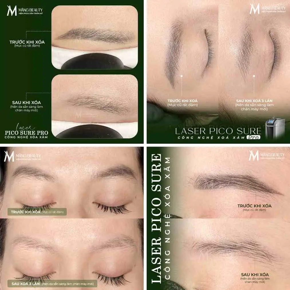 Hình ảnh khách hàng sau khi hoàn thành dịch vụ xoá chân mày tại Măng Beauty