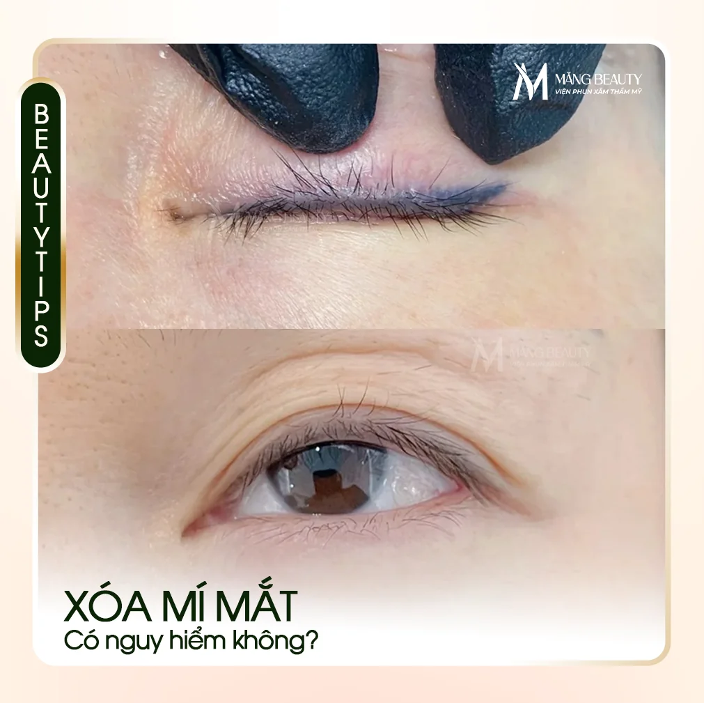 Xóa mí mắt có nguy hiểm không?