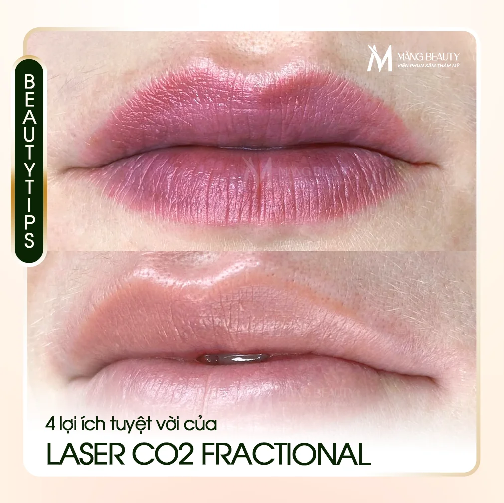 Laser CO2 fractional môi có tác dụng gì? 4 lợi ích tuyệt vời không thể bỏ qua