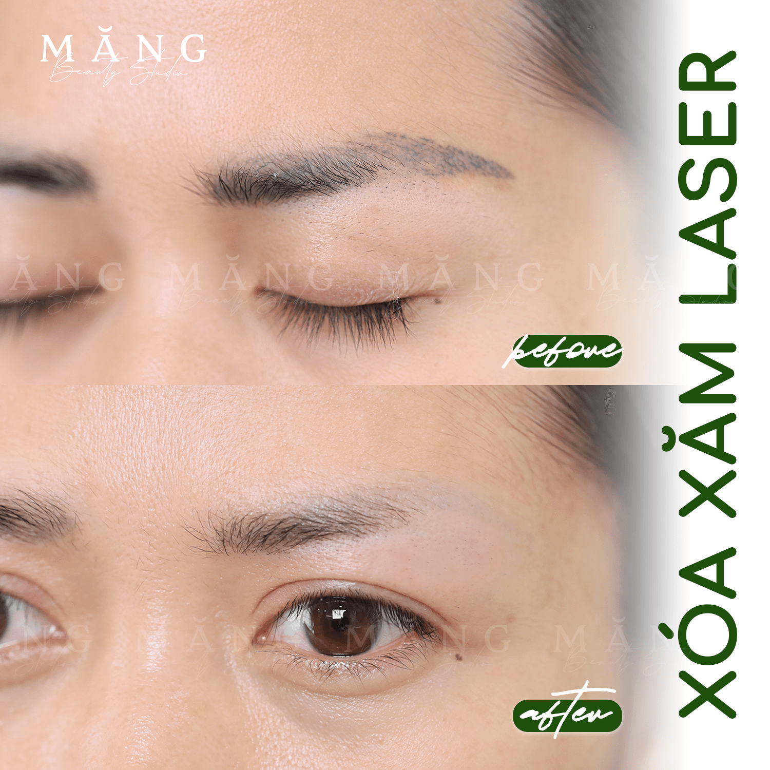 Xoá Laser tại Măng Beauty cực hiệu quả và nhanh chóng