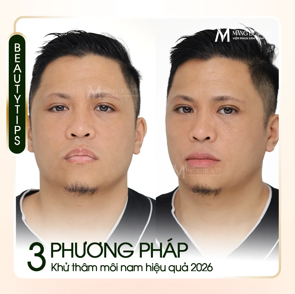 3 Phương Pháp Khử Thâm Môi Nam Hiệu Quả Nhất 2026