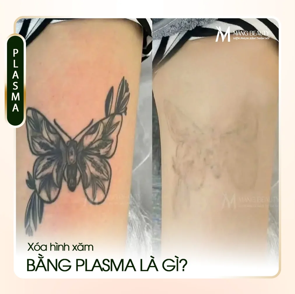 Xoá hình xăm bằng Plasma là gì? Vì sao được Măng Beauty lựa chọn