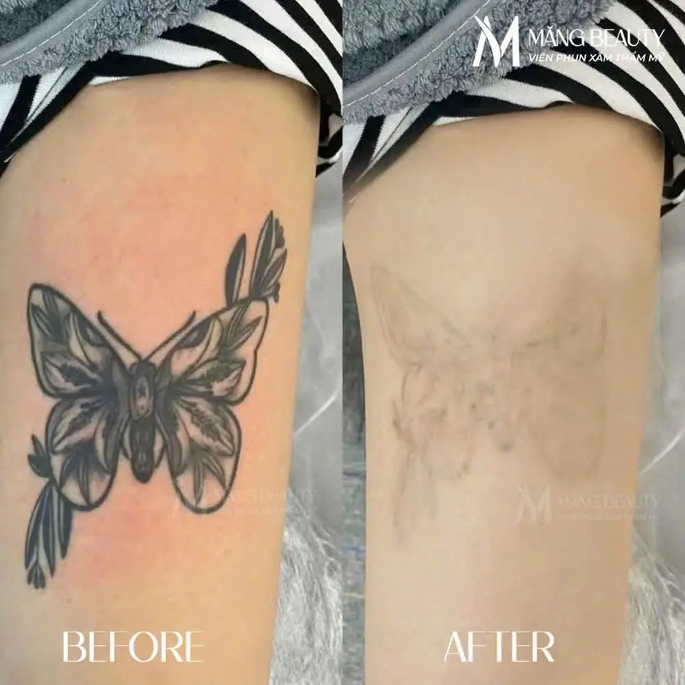 Hình ảnh thực tế sau khi xoá hình xăm bằng Plasma