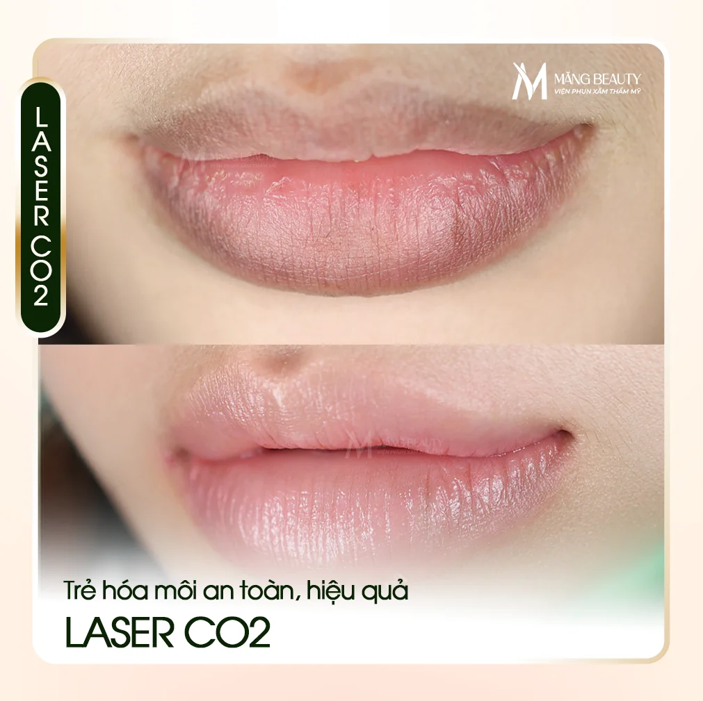 Laser Co2 - Giải pháp trẻ hóa môi an toàn, hiệu quả tại Măng Beauty
