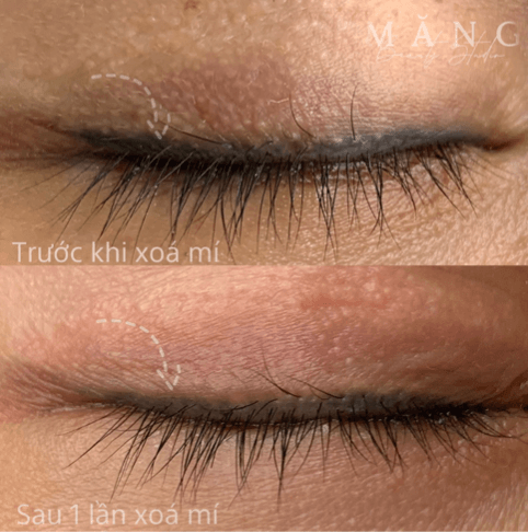 Măng Beauty - Địa chỉ xử lý mí phun trổ xanh uy tín