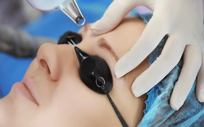 Xóa chân mày bằng laser an toàn, hiệu quả