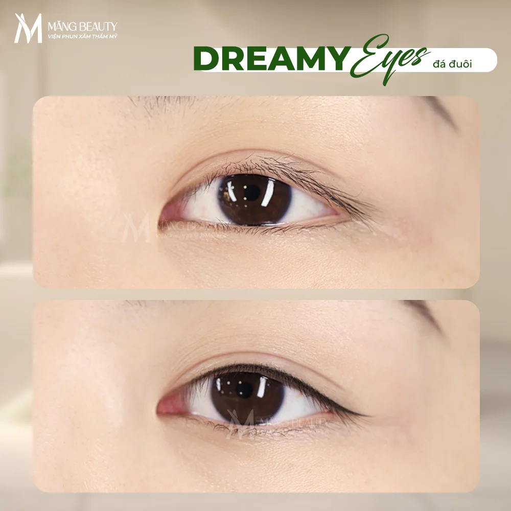 Phun mí tại Măng Beauty có đau không?