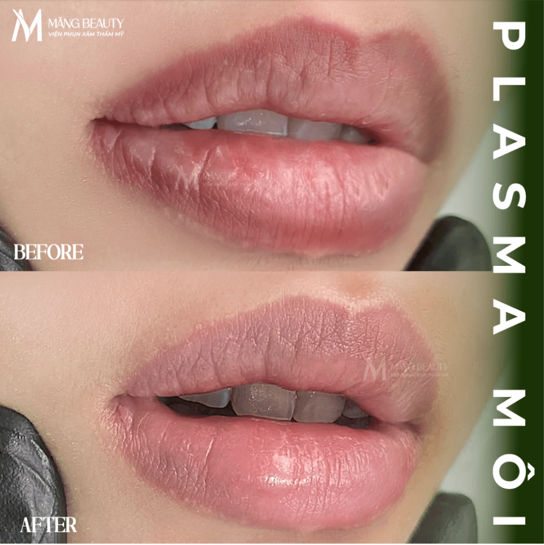 Quy trình phục hồi của môi sau khi bắn Plasma