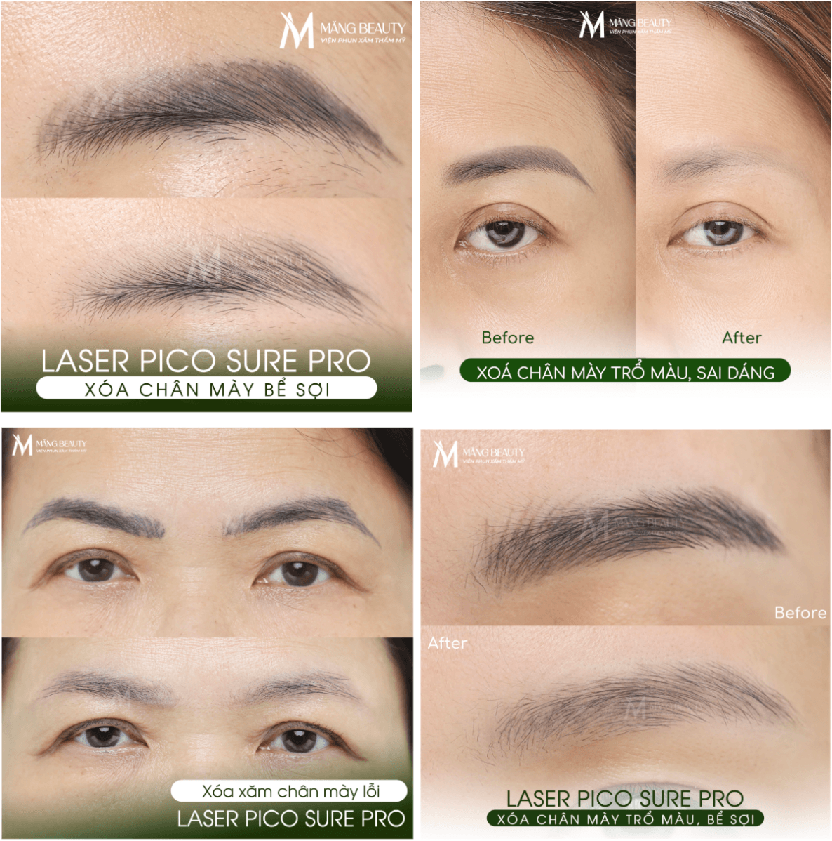 Hình ảnh khách hàng xóa chân mày bằng công nghệ Laser Picosure Pro tại Măng Beauty